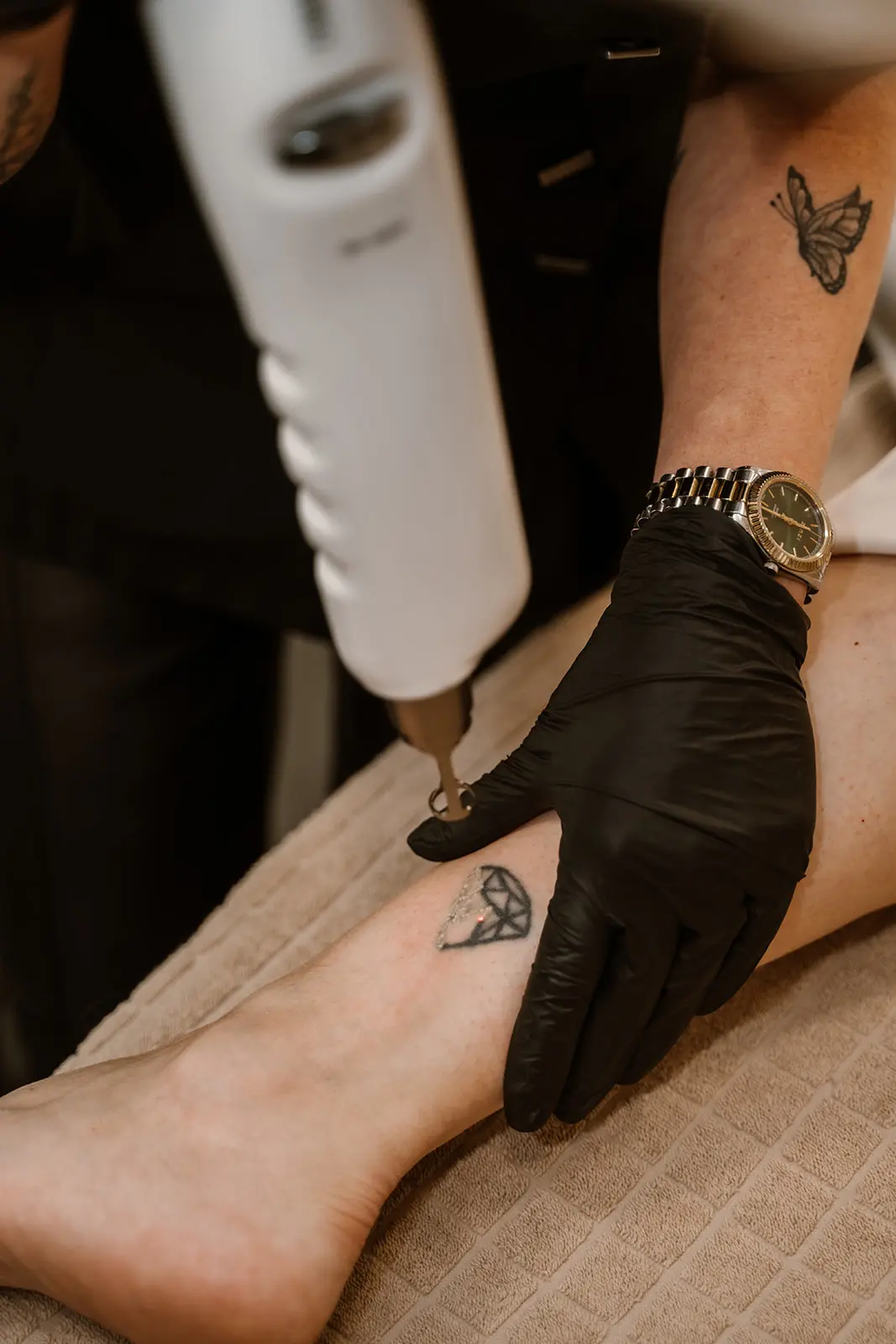 tattoo-verwijderen-closeup-total-body-control